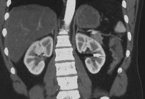 Abb. 4: CT-Scan mit Darstellung des Projektils in zentraler Position in der linken Niere.
