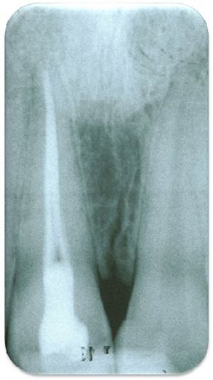 Abb. 4 a. Die Wurzelkanalfüllung an Zahn 11 weist scheinbar nur eine kleinere koronale Undichtigkeit auf.
