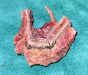 Abb. 4: Ausgeformtes Beckenkammtransplantat zum Ersatz des Unterkieferkorpus bei Osteoradionekrose nach Bestrahlung eines Mundbodenkarzinoms