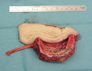 Abb. 7: Das gleiche Transplantat vor Rekonstruktion von Unterkiefer und Mundschleimhaut