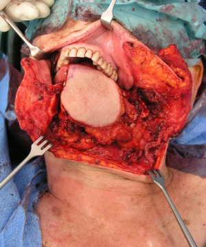 Abb. 8: Fall 1 vor En Block-Resektion des Tumors mit der halben Unterlippe und Kinn sowie Teilen der linkenWange und dem gesamten linken Mundboden