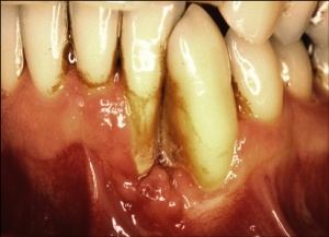 Abb. 3: Entzündeter Zahnhalteapparat (Paradontitis). Das Zahnfleisch ist gerötet und teilweise geschwollen, andererseits fehlt es zwischen den Zähnen.