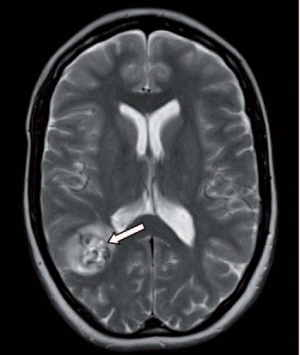 Abb 3: kraniales MRT mit T2-Wichtung in axialer Schnittführung: rechts parietookzipital gelegenes Kavernom (Pfeil) mit Einblutung und perifokalem Ödem