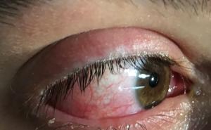 Akutes rotes Auge an Bord – eine diagnostische und therapeutische Herausforderung (Kasuistik)