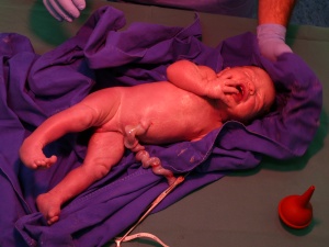 Abb. 3: Neugeborenes direkt nach der Geburt