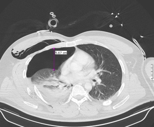 Abb. 3: Hämatopneumothorax rechts vor Anlage der Thoraxdrainage