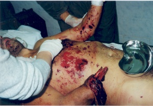 Erstversorgung eines durch eine Handgranate verletzten Abchasen durch das GMT Gali (Foto: H.R. Bauer)