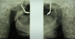 Abb 3: Panoramaschichtaufnahme mit Darstellung der 2D Implantatpositionen mit divergierender Achsrichtung