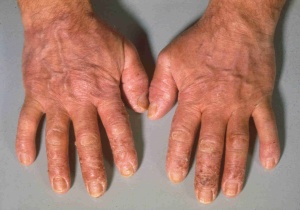 Abb. 7: Chronisches allergisches Handekzem mit ausgeprägter Lichenifikation und Nagelveränderungen