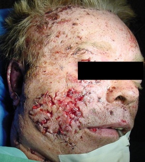 Abb. 2: Ausgedehnte Gesichtsweichteilverletzungen bei Fremdkörpereinsprengung nach Bombenexplosion.