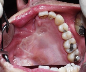 Abb. 8: Intraorale Darstellung des Oberkiefers. Es fehlen der Oberkieferknochen und sämtliche Zähne der betroffenen Kieferhälfte.
