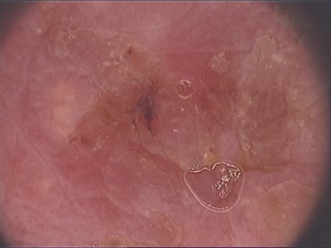 Abb 2: Auflichtmikroskopisch bei 3 Uhr und 9 bis 11 Uhr: Krustenbildung und inhomogene dunkelrot-bräunliche Verfärbung in der zentralen Läsio