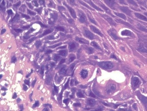 Abb 3: Hochgradig atypische Zellen im Epithel.