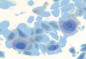 Abb 5: CK7-positive Paget-Zellen.