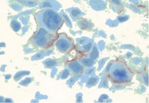 Abb 6: HER2neu: Paget-Zellen positiv.