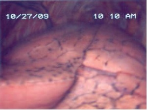 Abb 2: Thorakoskopische Ansicht der linken Lunge mit Blick auf den Lappenspalt.