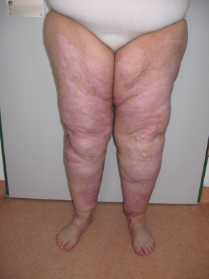 Abb. 8: Narbenbefund Beine 8 Monate nach Trauma