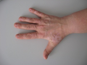 Abb. 9: Narben rechte Hand 10 Monate nach Trauma