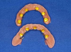 Abb. 1: Weit nach bukkal extendierte Kunststoffanteile zur Unterstützung des Lippenprofils bei Galvano- Doppelkronenprothesen