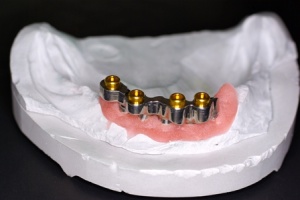Abb. 3: Individuell gefräster Steg als Verankerungselement für abnehmbaren implantatgetragenen Zahnersatz
