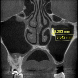 Abb. 2: Radiologische Darstellung und Ausdehnung des Wurzelfragments im Sinus Maxillaris