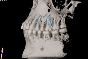 Abb. 5: 3-D Darstellung der verlagerten überzähligen Zähne im Oberkiefer