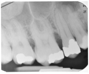Abb. 9: Radiologische Darstellung der Oberkieferseitenzähne. Dabei imponiert eine periapikale Aufhellung am Zahn 14