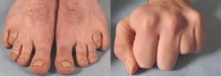 Abb 1: 23-jähriger Patient mit Brachydaktylie 4. Strahl Hände und Füße: keine Therapiekonsequenz