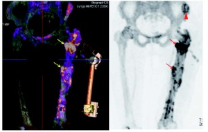 Abb 5: Vitalitätsdiagnostik (Fluorid-PET/CT, 3D- Rekonstruktion).