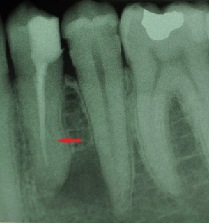 Unbehandeltes, tief abzweigendes Kanalsystem des Zahnes 34 als Ursache persistierender Beschwerden.