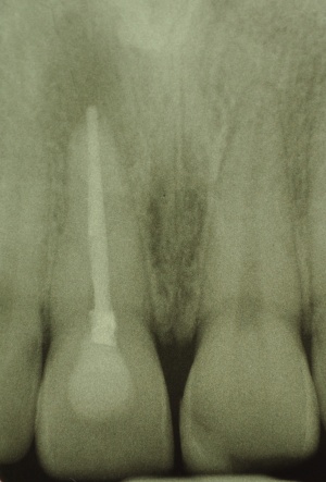 Radiographisch suffiziente, überextendierte Wurzelfüllung mit apikaler Parodontitis des Zahnes 11.