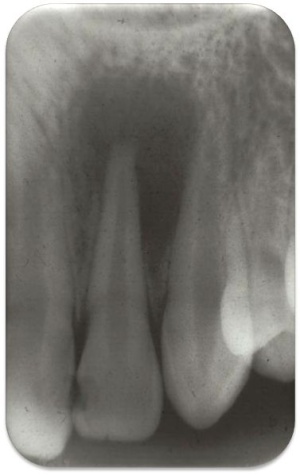 Abb. 3: An Zahn 22 liegt eine ausgedehnte, aber (noch) asymptomatische Parodontitis apicalis vor.