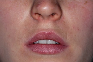 Abb. 1: Inspektion der Lippe bei geöffnetem Mund.