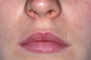 Abb. 1: Inspektion der Lippe bei geschlossenem Mund.