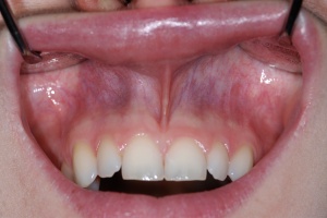 Abb. 2: Inspektion der Lippenmukosa, des labialen Vestibulums und der Lippenbändchen bei halb geöffnetem Mund.