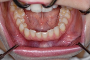 Abb. 2: Inspektion der Lippenmukosa, des labialen Vestibulums und der Lippenbändchen bei halb geöffnetem Mund.
