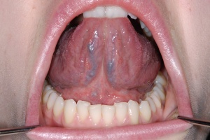 Abb. 4: Inspektion der Zungenunterseite.