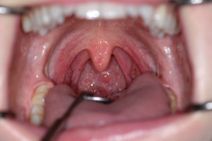 Abb. 11: Inspektion des weichen Gaumens, der Uvula und des Rachens.