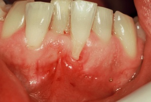 Abb. 1: Singuläre parodontale Rezession am Zahn 31 mit Rötung, Schwellung und Plaqueakkumulation