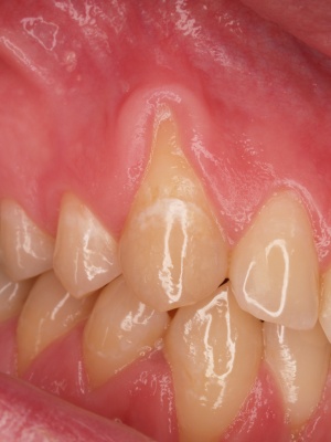 Abb. 2: Singuläre parodontale Rezession am Zahn 13
