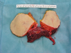 Abb. 10: Zweiteiliger ALT-Flap vor Transplantation in Fall 1 (absteigender Ast der A. circumflexa femoris lateralis mit den zwei Venae comitantes)