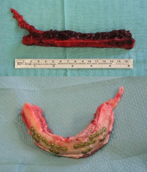 Abb. 13: Fibula nach Entnahme und ausgeformtes Fibulatransplantat in Fall 2