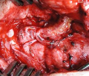 Abb. 16: Gefäßanastomosen bei einem voroperierten und bestrahlten Patienten. Anschluss der Arterie an die A. thyreoidea sup.