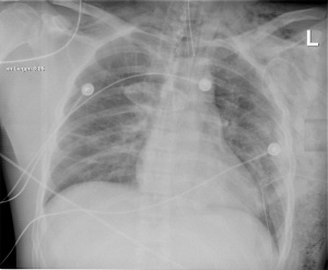 Abb. 4: Kontrollthoraxröntgen 10 Stunden postoperativ (Photo:Wolff / Korban)