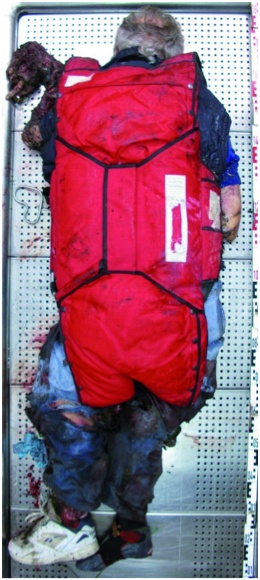 Abb. 5: Aussparung des Rückens von penetrierenden Verletzungen bei zum Unfallzeitpunkt getragenem Fallschirm