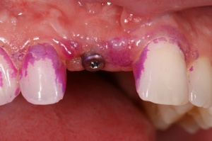 Abb. 3: Durch Anfärben gut sichtbarer oraler Biofilm an den Zähnen 12 und 21. (Foto: Berger)