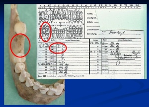 Abb. 7: Während der Bundeswehrzeit durchgeführte Extraktionen im rechten Unterkiefer: Zähne 46 und 47