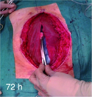 Abbildung 3: Implantation eines Vicrylnetzes auf Faszienniveau über dem Viszeralschutz (72 h nach Anlage des Laparostomas)