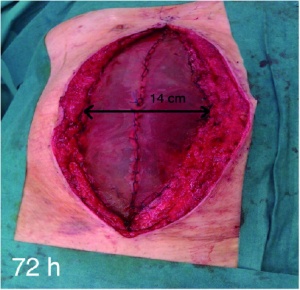 Abbildung 4: Fasziendehiszenz von 14 cm nach erfolgter Vicrylnetz-Implantation