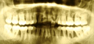 Abb. 3: Patient, männlich, 32 Jahre, Diagnose: Generalisierte aggressive Parodontitis.